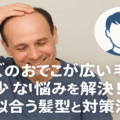 メンズのおでこが広い&毛量が少ない悩みを解決!似合う髪型と対策法