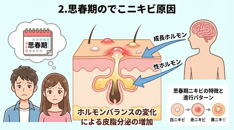 2.思春期のでこニキビ原因